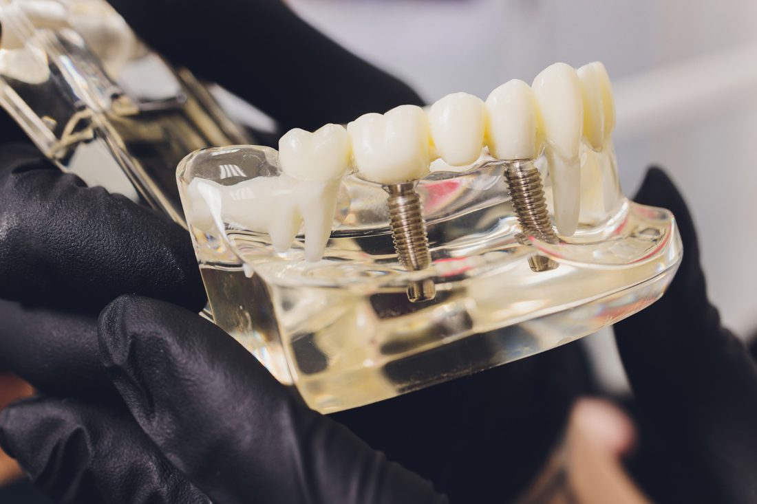 Implant Dentistry in Monroe, CT